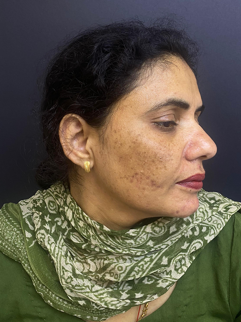 Before treatment
